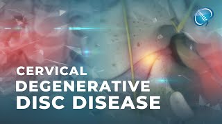 What is Cervical Degenerative Disc Disease  DDD [upl. by Harima585]