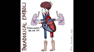 Embolic Events Stroke vs PE vs Paradoxical Emboli [upl. by Barnabe103]