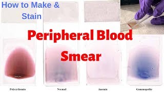 Peripheral Blood Smear Peripheral Smear Examination  Leishmans Staining Procedure [upl. by Thomasa]