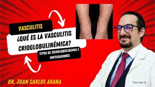 Vasculitis crioglobulinémica la gran olvidada [upl. by Yerhpmuh]