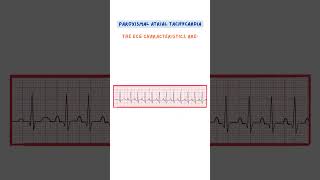 Paroxysmal Atrial Tachycardia ecg medical medicalstudent medschool medicaleducation doctor [upl. by Ettenay590]