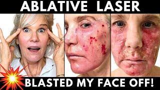 Skin LASER RESURFACING My One Year Recovery Journey Week by Week [upl. by Artenehs30]