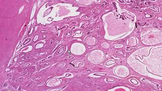 Endometrial Polyp Histopathology  Madeformedicalcom [upl. by Etra]