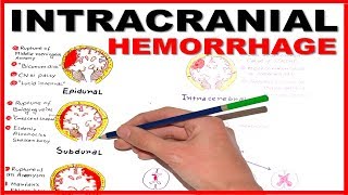 Intracranial Hemorrhage EpiduralSubduralSubarachnoid overview [upl. by Venditti97]