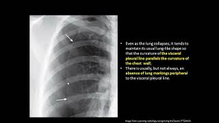 Lecture 7  Pneumothorax pneumomediastinum pneumopericardium and subcutanous emphesyma [upl. by Werdn]