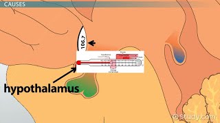 Pyrexia Fever Hyperthermia What is the difference [upl. by Annaeel]