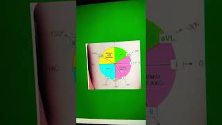 Left axis deviation in ECG [upl. by Jermaine750]