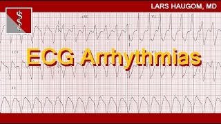 ECG Arrhythmias [upl. by Akiner]