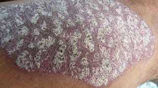 Psoriasis rash pictures skin condition disorder dry skin images symptoms [upl. by Marguerie]