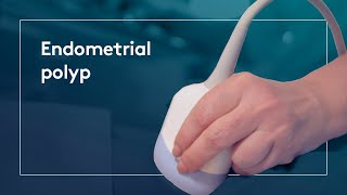 What is an Endometrial polyp [upl. by Morissa]