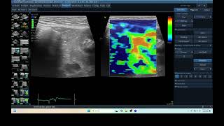 IW 262 ADRENO ELASTOGRAPHY ECHOPAC ANALYSIS ULTRASOUND PDH [upl. by Mensch361]