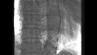 Dense Calcification in the Aorta [upl. by Fahy50]