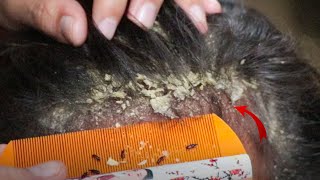 Removed Hundred of Lice From Head and Dry Scalp Huge Dandruff of Flakes Removal With Comb  1765 [upl. by Anailuy]