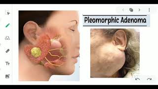 PLEOMORPHIC ADENOMA  SALIVARY GLAND TUMOR  ORAL PATHOLOGY  ORAL CANCERS [upl. by Akino]