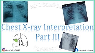 Chest Xray interpretation made easy III [upl. by Emarie433]