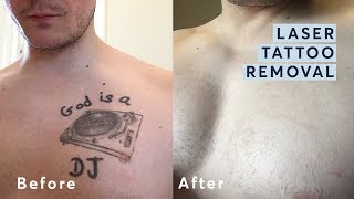 Laser Tattoo Removal  Before and After through all the stages [upl. by Fulvia]