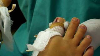 Ingrown Toenail Removal [upl. by Nylaroc]