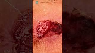 What is squamous cell carcinoma  Shorts [upl. by Kamin]