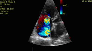 Echocardiogram Cor Pulmonale PHTN Pulmonary Hypertension [upl. by Anaidni]