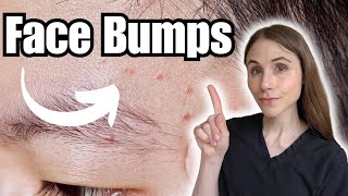 Face Bumps THAT ARE NOT Fungal Acne [upl. by Llenral]