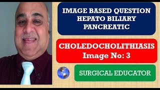 CHOLEDOCHOLITHIASIS  Hepato Biliary Pancreatic Image 3 [upl. by Selestina171]