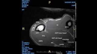 MRI partial rupture radial collateral ligament MCP 1 joint [upl. by Ninon]