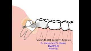 extraction dent de sagesse inférieure قلع ضرس العقل avec anatomie spéciale [upl. by Ennoryt268]