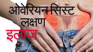 Ovarian cyst ke lakshan  Ovarian cyst kaise thik kare  ओवरी में गाँठ  Ovarian cyst kya hota hai [upl. by Ennaeilsel]