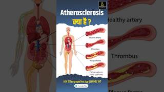 Atherosclerosis के क्या है  Causes sign and symptoms atherosclerosis testpaperlive shorts [upl. by Primalia]