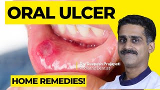 Understanding Oral Ulcers Causes Symptoms and Treatment Options [upl. by Dnanidref]