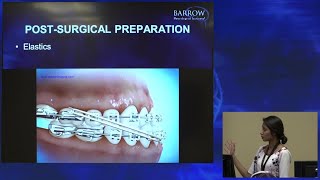 Role of Braces Before amp After Jaw Surgery [upl. by Sorkin600]