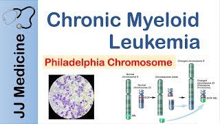 Chronic Myeloid Leukemia CML  Pathogenesis Symptoms and Treatment [upl. by Alwyn]