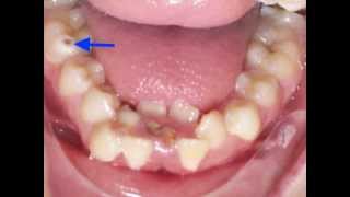 Lower Incisor Extraction Time Lapse Video Kyger Orthodontics [upl. by Nabalas]