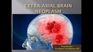 12Extraaxial brain neoplasm [upl. by Desberg]