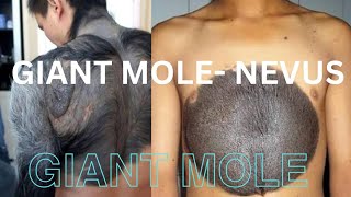 quotEffective Mole amp Nevus Treatment Your Comprehensive Guidequot [upl. by Maier770]