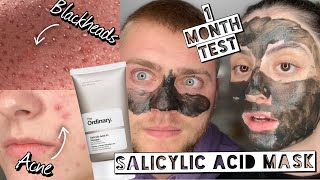 TESTING THE ORDINARY SALICYLIC ACID MASQUE ON ACNE amp BLACKHEADS FOR 1 MONTH Ft My Boyfriend [upl. by Herson]