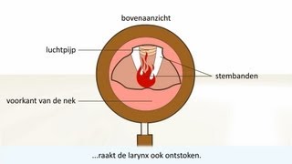 Keelontsteking  de oorzaak en behandeling [upl. by Ainotna]