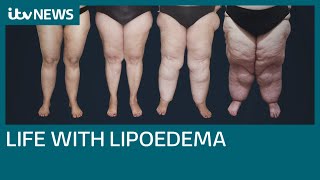 Campaigners call for more help on the NHS for painful Lipoedema  ITV News [upl. by Ezeerb]