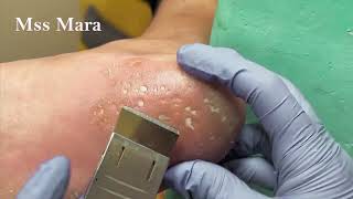 Mss Mara Ep42  Foot Care Clean the Skin and remove the corner of the nail Podología Integral [upl. by Leemaj]