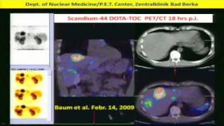 Neuroendocrine Tumors Diagnosis amp Treatment w Peptide Receptor RadiotherapyPRRT Dr Baum 2of2 [upl. by Rose]