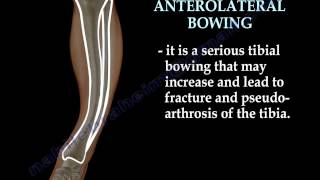 Tibial Bowing  Everything You Need To Know  Dr Nabil Ebraheim [upl. by Ahsinid]