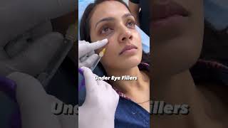 under eye filler treatment helps you get rid of wrinkles  Dermalyn Aesthetics  Dr Muskan Tyagi [upl. by Munmro846]