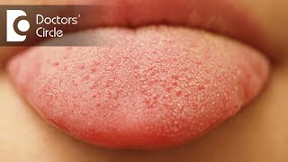 What causes small red patches on tongue  Dr Sana Taher [upl. by Stafani]