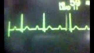 ECG Video AV Block  First Degree [upl. by Malaspina]