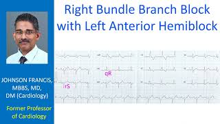 Right bundle branch block with left anterior hemiblock [upl. by Mcginnis]