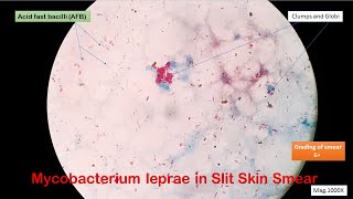 Positive slit skin smear of Leprosy patient with grading of 6 plus [upl. by Aistek]