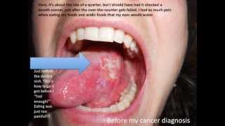 Young Person with Tongue Cancer Do you have it Wake the health up [upl. by Seely]