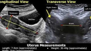 How to measure Uterus on ultrasoundLengthWidth Diameter [upl. by Stoffel]