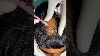 Alopecia Areata Treatment For Hair Growth  Treatment Of Alopecia  Skinaa Clinic shorts viral [upl. by Acinoj]