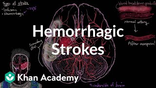 Hemorrhagic strokes  Circulatory System and Disease  NCLEXRN  Khan Academy [upl. by Lorna]